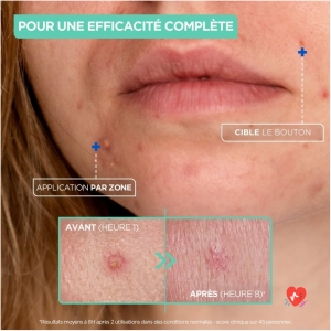 Soin anti boutons ciblé Pimple Paste